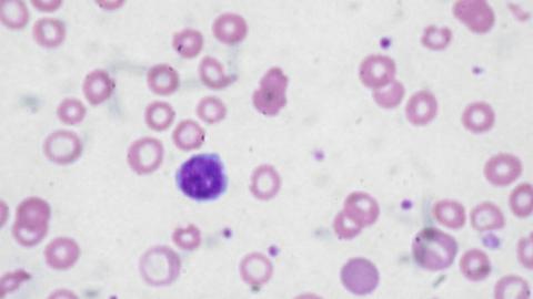 Anemia: Recognizing the Symptoms and Blood-Boosting Foods
