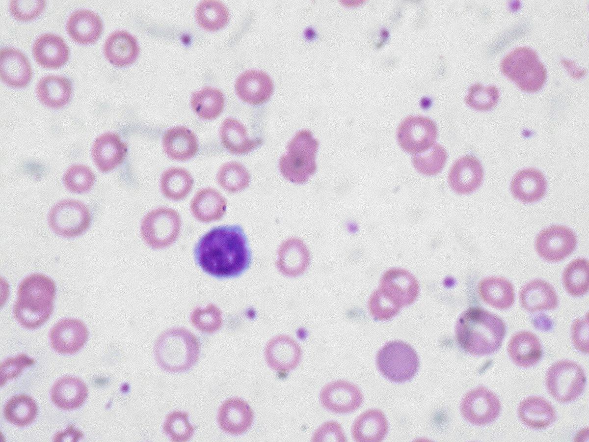 Anemia: Conozca los síntomas de la falta de sangre y los alimentos…