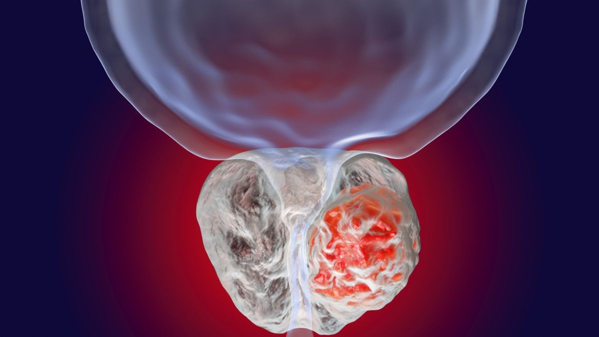 前立腺がん：男性は早期から症状を認識せよ