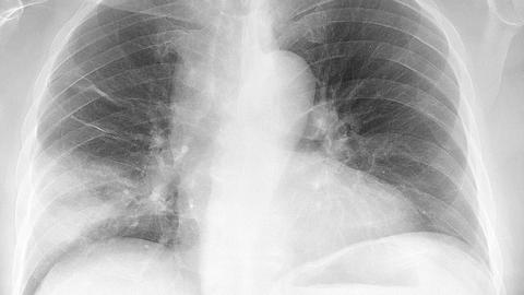 Pneumonie : les symptômes chez l’enfant et l’adulte qu’il faut…